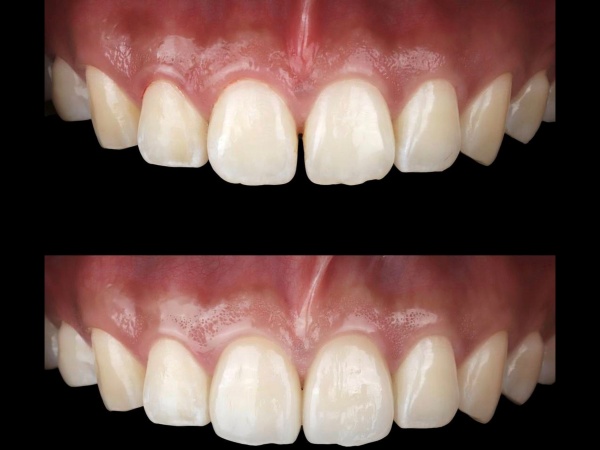 ラミネートべニア