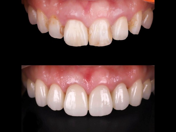 ６前歯フルカントゥアージルコニア