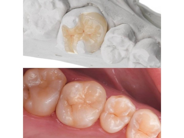 プレスインレー